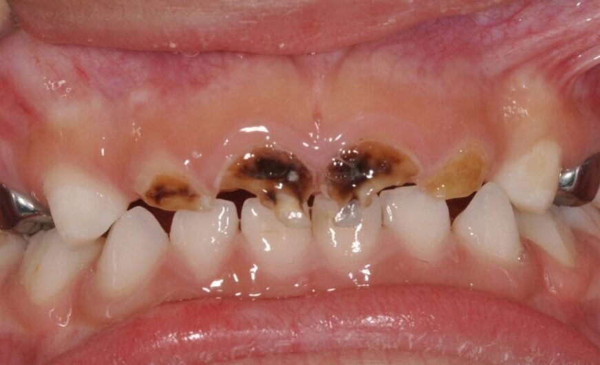 Do you know your sweet kisses could spread cavity-causing bacteria to your child?